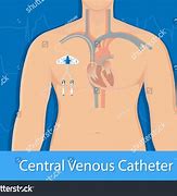 Image result for Central Venous Catheter vs PICC