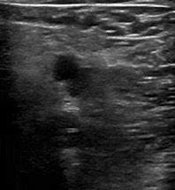 Image result for Dermoid Ultrasound