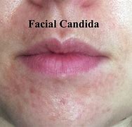 Image result for Candida Albicans Skin