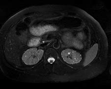 Image result for Lithium Renal
