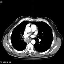 Image result for Carcinoid Tumor Bronchoscopy