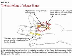 Image result for Trigger Finger Medscape