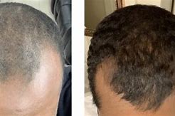Image result for Minoxidil Before and After