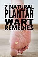 Image result for Planters Warts Treatments