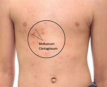 Image result for Treatment for Molluscum Contagiosum in Toddlers