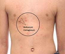 Image result for Molluscum Contagiosum Baby