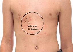 Image result for Stages of Molluscum