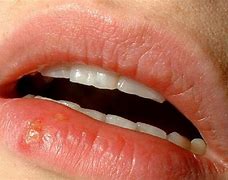 Image result for Lip Wart Removal