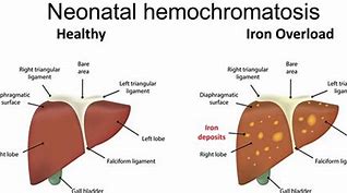 Image result for hejocromatosis