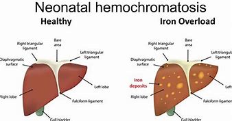 Image result for hemicromatosis