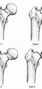 Image result for Femoral Neck Fracture Types