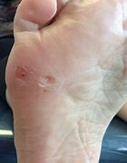 Image result for Pictures of Plantar Warts