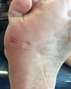 Image result for Plantar Wart On Side of Foot