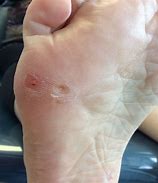Image result for Plantar Wart Pictures On Feet