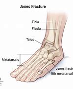 Image result for Jones Fracture Foot