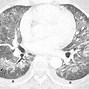 Image result for Viral Pneumonia Chest X-Ray