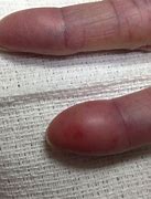 Image result for Swollen Finger Tip