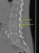 Image result for Osteoporotic Vertebral Compression Fracture