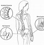 Image result for osteoporosis