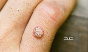 Image result for Common Wart Removal