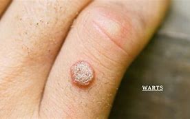 Image result for Finger Wart Removal
