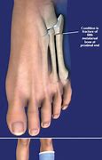 Image result for Jones Fracture Foot Symptoms