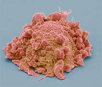 Image result for Colorectal Cancer Cell Sem