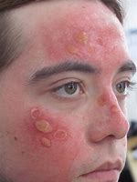 Image result for Sun Burn Skin Severe