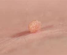 Image result for Canine Papilloma