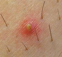 Image result for Ingrown Hair On Arm