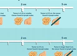 Image result for How Big Is 6 Cm Tumor