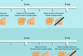 Image result for Tumor Size mm