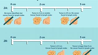 Image result for How Big Is a 10 Cm Tumor