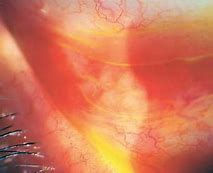 Image result for Chlamydia in Eye