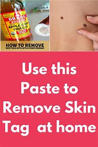 Image result for Home Remedy Skin Tag Remover