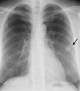 Image result for Multiple Lung Nodules