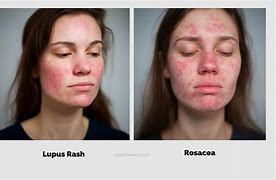 Image result for Rosacea vs Lupus