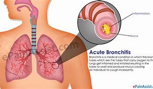 Image result for bronchit