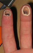 Image result for Lamprey Disease Human Skin