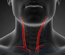 Image result for Twisted Carotid Artery Neck
