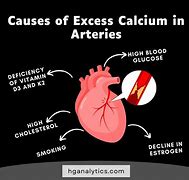 Image result for Carotid Artery Calcification