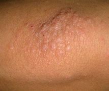 Image result for Elbow Warts