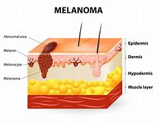 Image result for What Does Melanoma Look Like