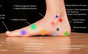 Image result for Foot Pain Chart