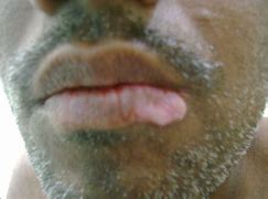 Image result for Lata Condyloma Lesions