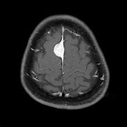 Image result for Meningioma Tumor MRI Images