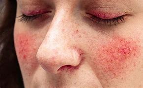 Image result for What Does Rosacea Look Like