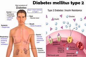 Image result for diabetes_mellitus