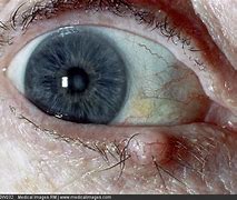 Image result for Papilloma Eye