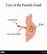 Image result for Parotid Gland Cyst